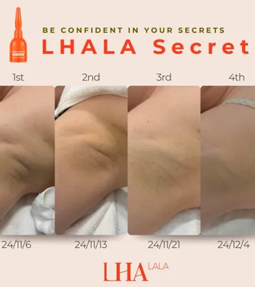 LHALA Peel cosmetic outcome image 1