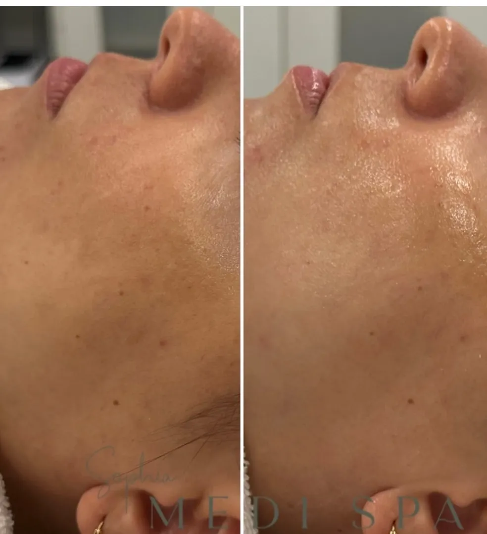 LHALA peel treatment visual 1