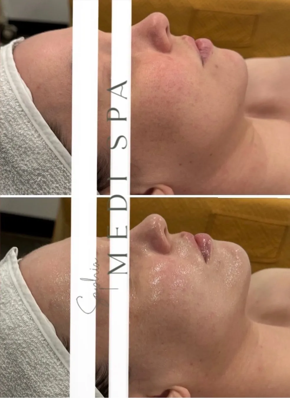 LHALA peel treatment visual 2