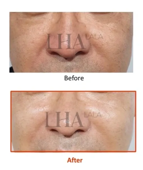 LHALA peel treatment visual 4